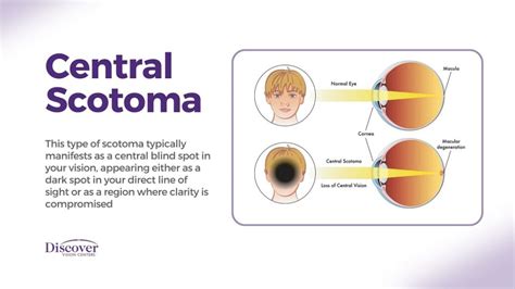 scotomaphobia|Scotoma